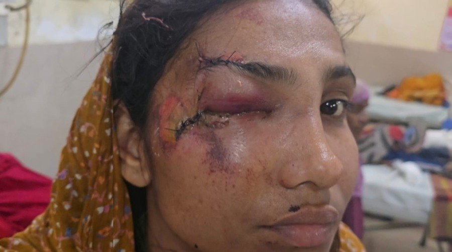 चाइनीस मांजा हादसा: बोरखेड़ा ओवरब्रिज पर रीट परीक्षा देकर लौट रही युवती गंभीर घायल, एमबीएस अस्पताल में भर्ती